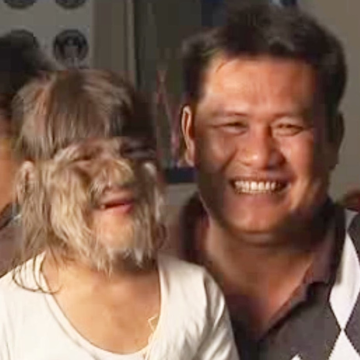 Natty's teacher, Kuljira Posaeng, revealed that other kids were initially scared of Natty's appearance. Close up of a girl smiling with a man, her face covered in fur-like hair, homely background.