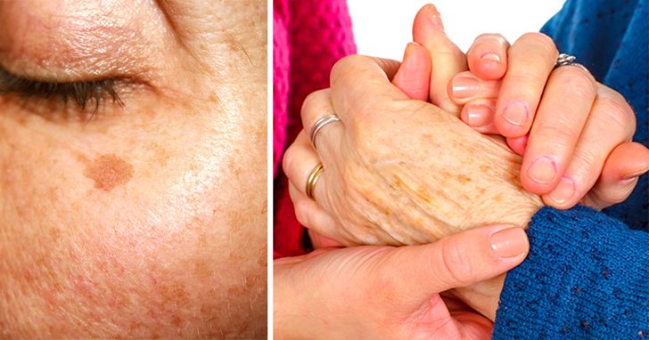 11 Ways To Remove Dark Spots From Your Skin