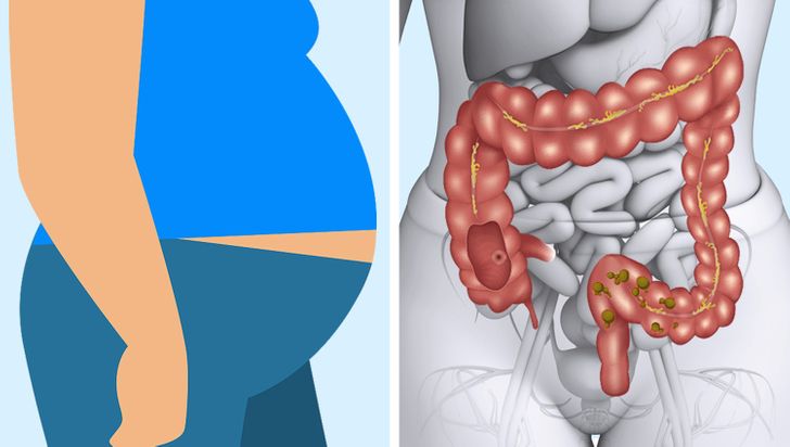 Blähungen nach dem Essen von Fleisch