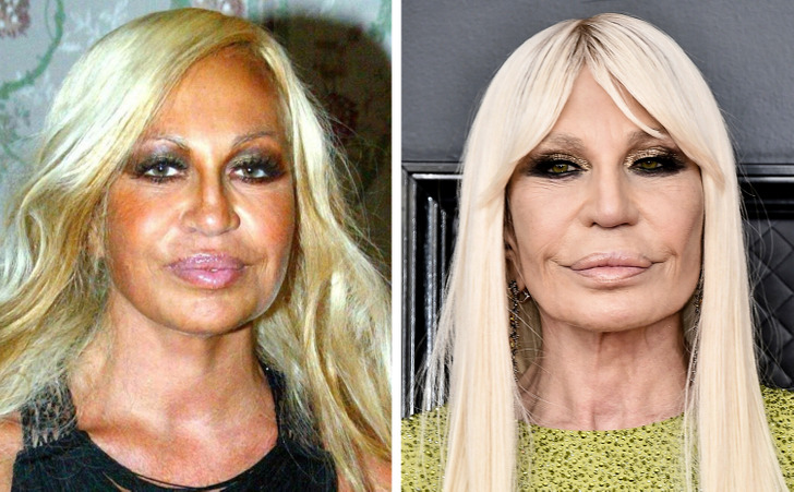 donatella versace - a before and after  Celebrity plastic surgery, Donatella  versace plastic surgery, Plastic surgery