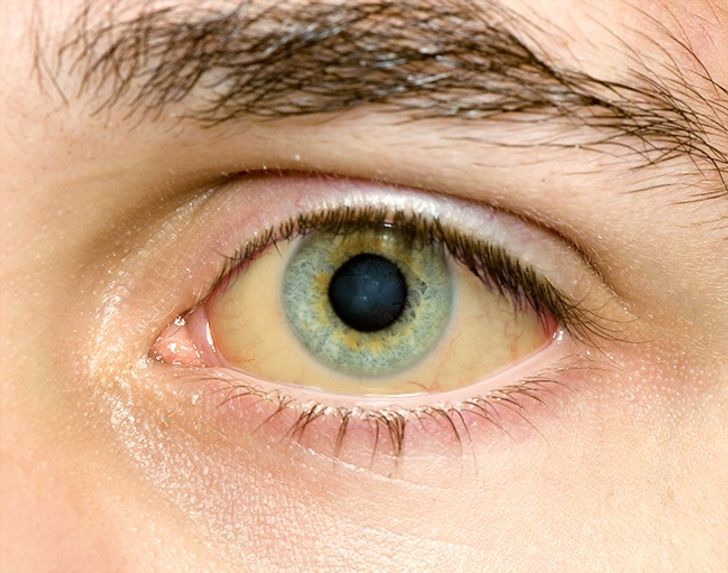12 Things Your Eyes Can Tell About Your Health