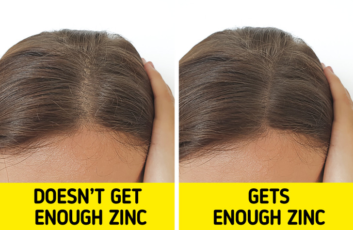ZINC  HAIR LOSS GROWTH  My Hair Doctor  Prescription Haircare