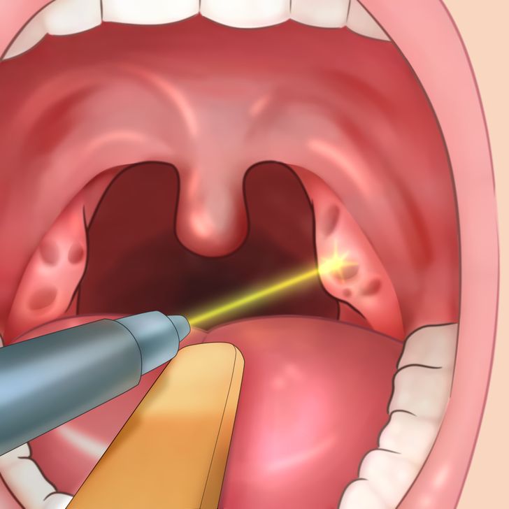 11 Tips for Removing Tonsil Stones That’ll Make You Sigh With Relief