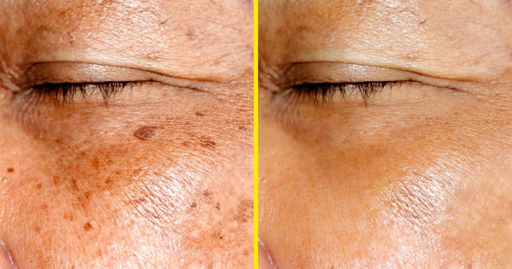 11 Ways to Remove Dark Spots From Your Skin