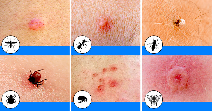 Identifying Common Summer Bug Bites