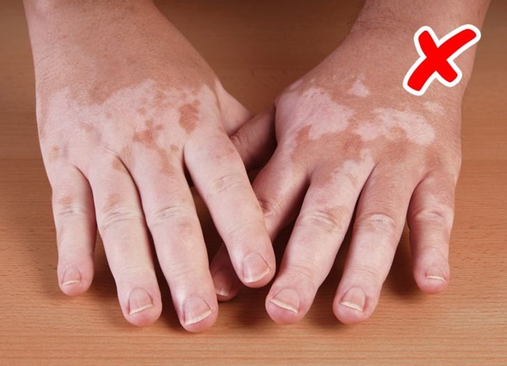 8 Serious Diseases Signaled by Our Skin