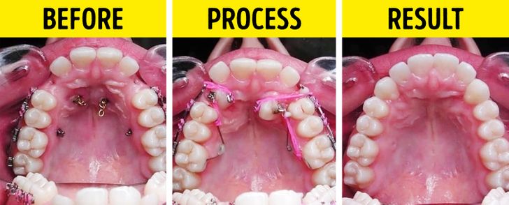 Can braces help you lose weight