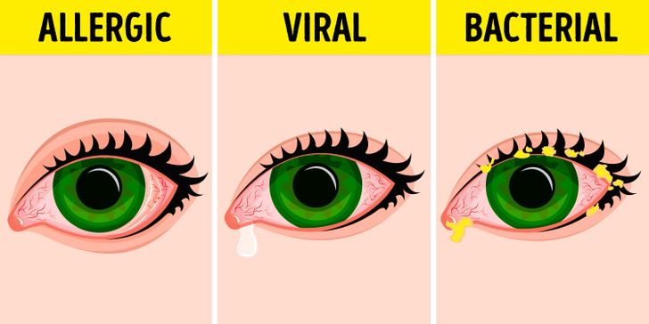 14 Effective Ways to Treat and Prevent Eye Infections Naturally