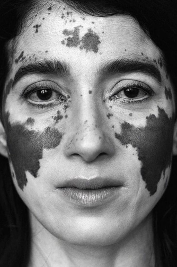 A Photographer With Vitiligo Captures the Beauty of Women With the Same Condition, and It’s a Sight to Behold