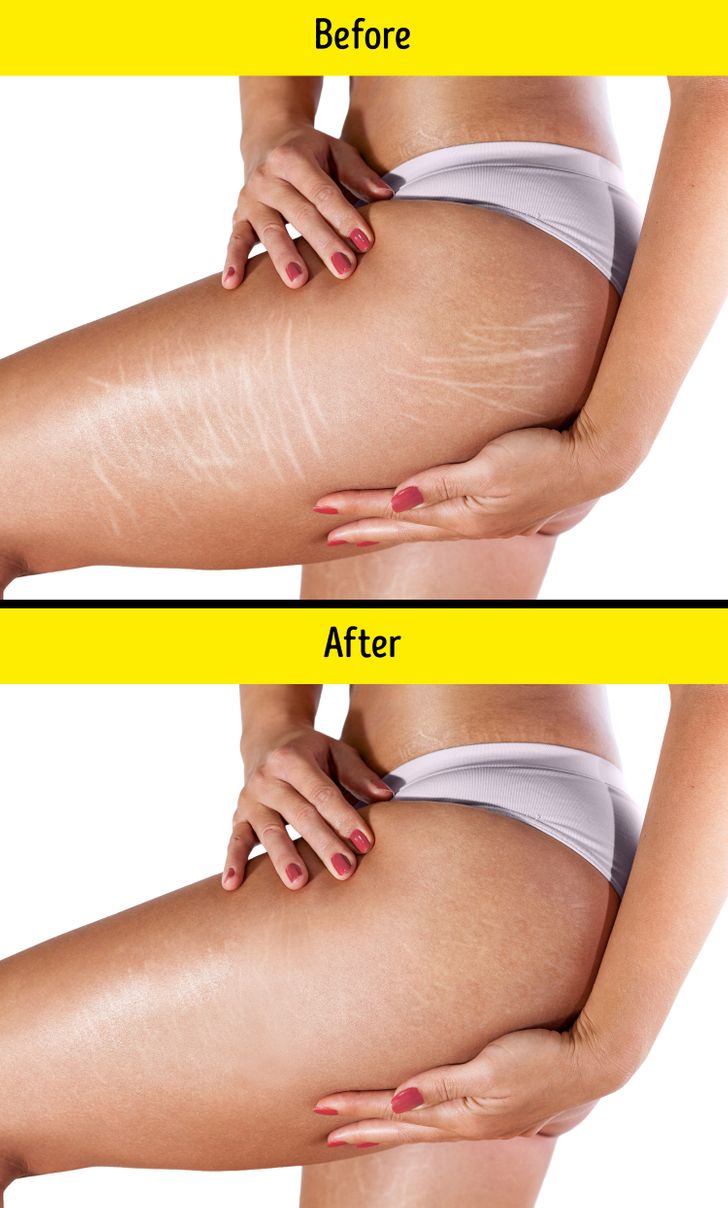 How to Prevent Stretch Marks and What to Do If You Already Have Them