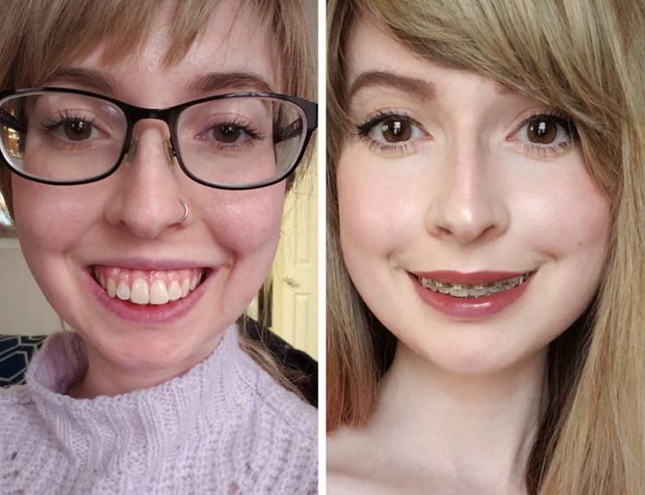 20+ Girls Who Decided to Get Plastic Surgery and Proved There Are No Limits When It Comes to Perfection