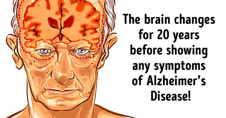 6 Proven Ways to Prevent Alzheimer’s Disease