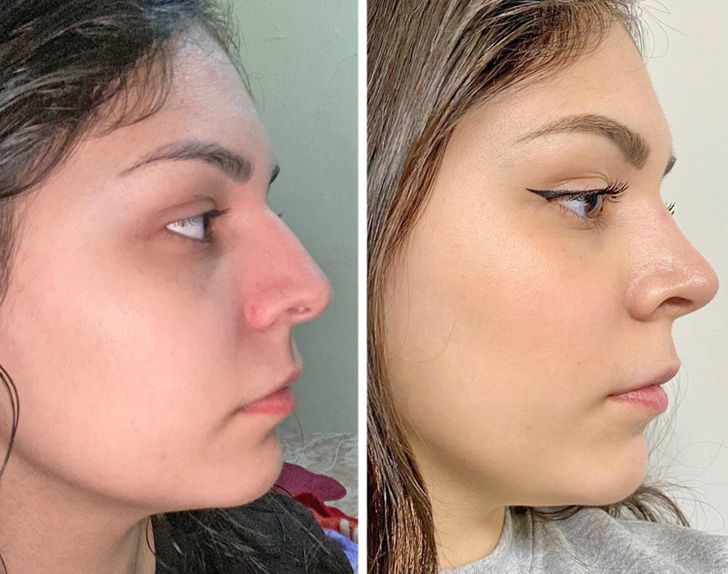 20+ Girls Who Decided to Get Plastic Surgery and Proved There Are No Limits When It Comes to Perfection