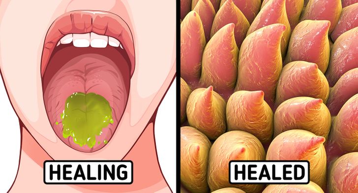 How To Cure A Burned Tongue