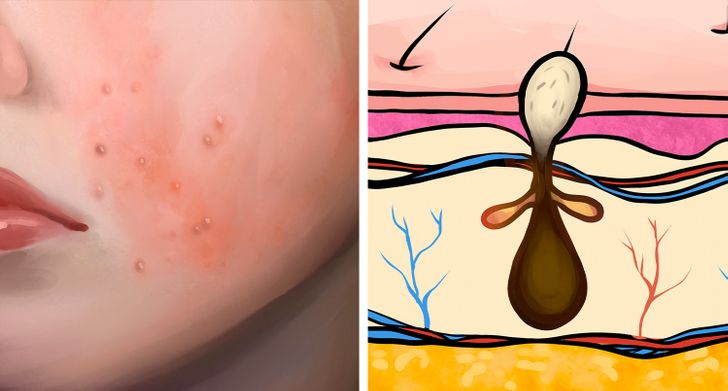 6 Types of Acne and What Might Cause Them