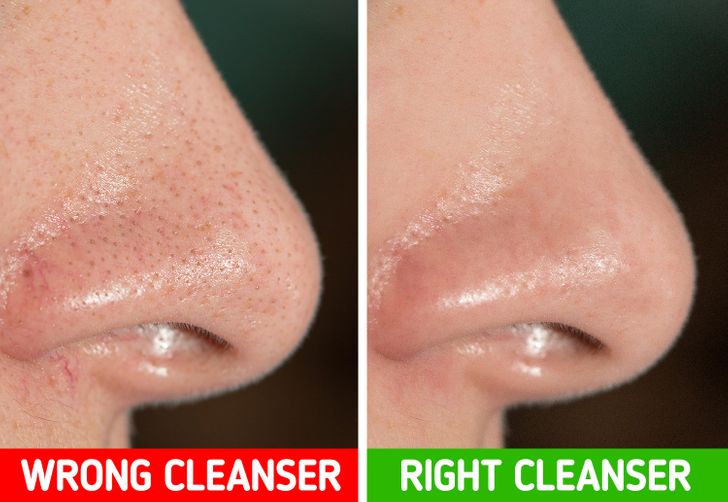 enlarged pores nose