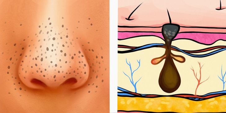 6 Types of Acne and What Might Cause Them