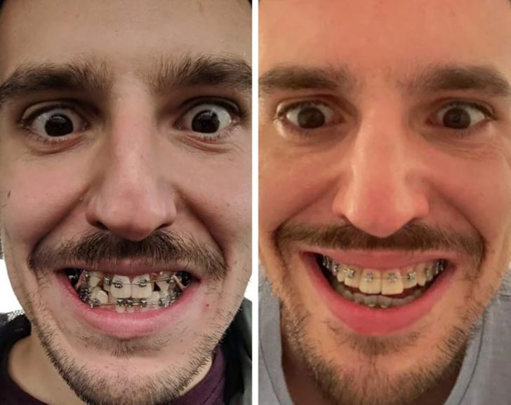 Herkesin Dişlerinin Mükemmel Bir Gülüşe Dönüştürülebileceğini Kanıtlayan 15 Fotoğraf