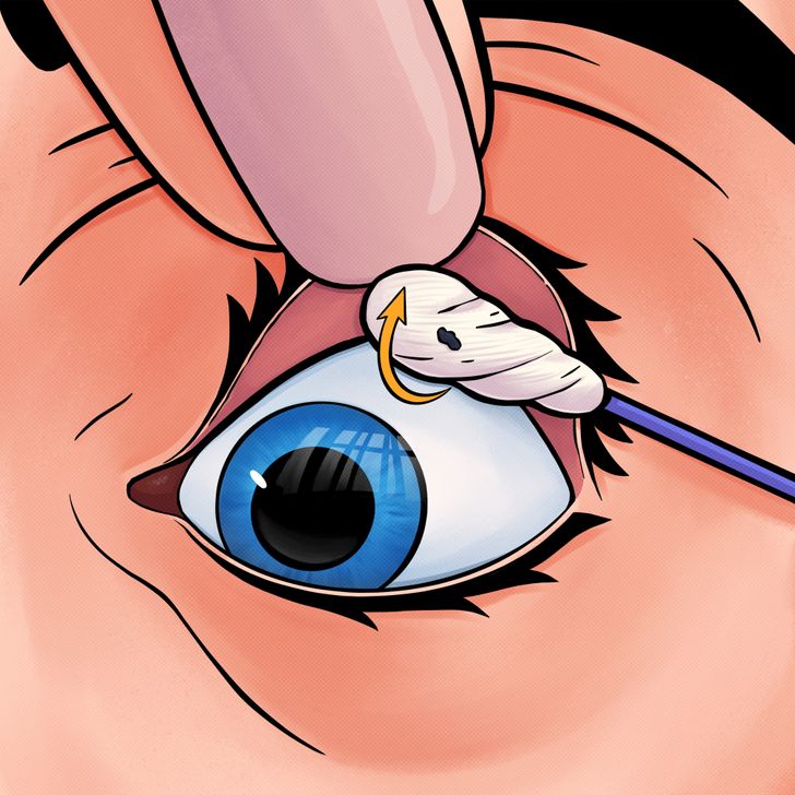 7 Ways To Safely Remove Something Stuck In Your Eye Bright Side