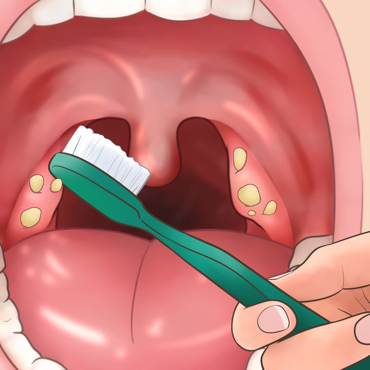 11 Tips for Removing Tonsil Stones That’ll Make You Sigh With Relief