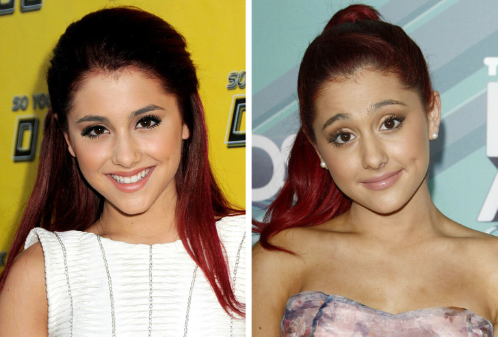 Ariana Grande Lip Injections