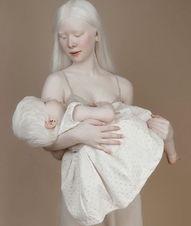 Albino Sisters Born 12 Years Apart Excite the Internet With Their Photos