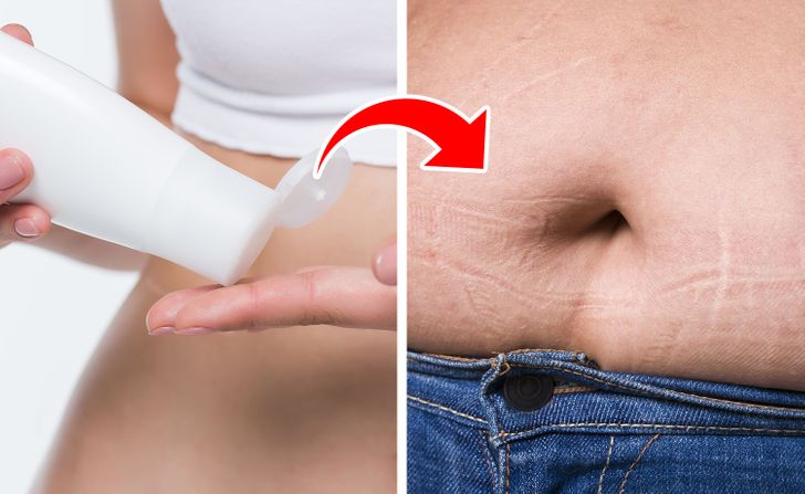 6 Ways to Make Your Stretch Marks Less Visible