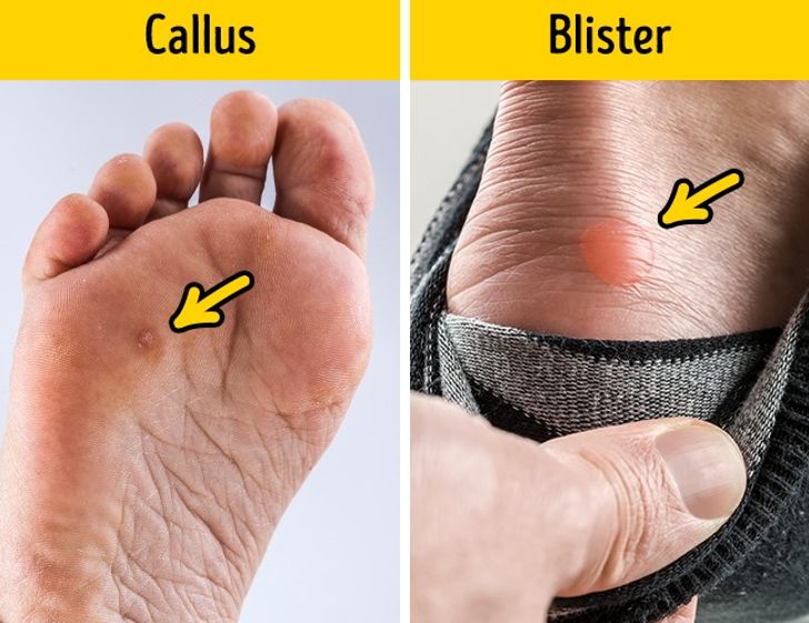 blisters on toes from heels
