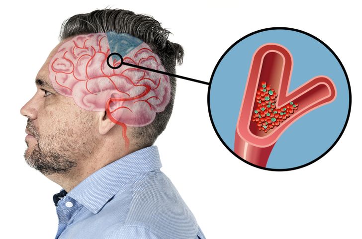 6 Warning Signs That Show a Stroke Is Coming, and It’s Really Important to Know Them