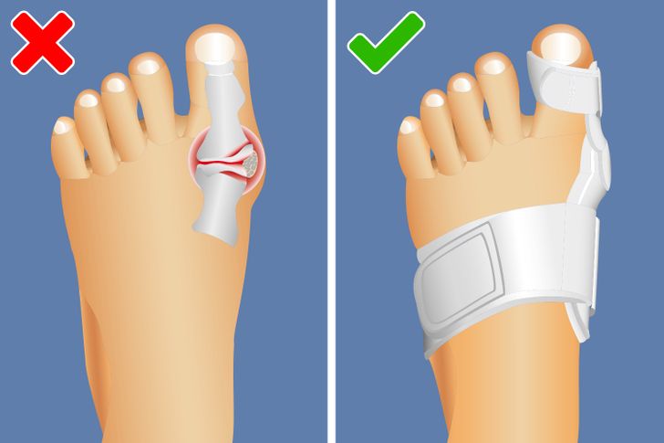 6 Easy Ways to Shrink Your Bunions Without Surgery