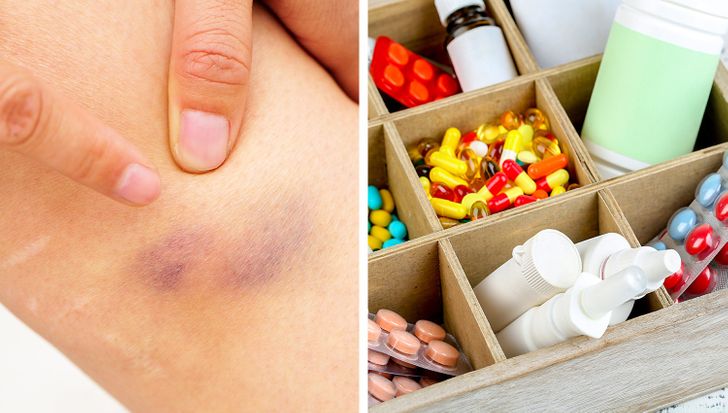 If You Have Unexplainable Bruises on Your Body, Here Are 7 Health Problems That Can Be the Reason