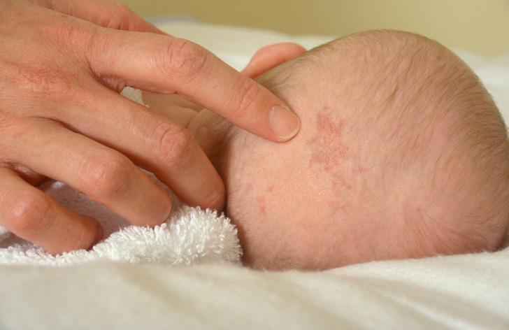 A hand pointing to a birthmark on a newborn's forehead.