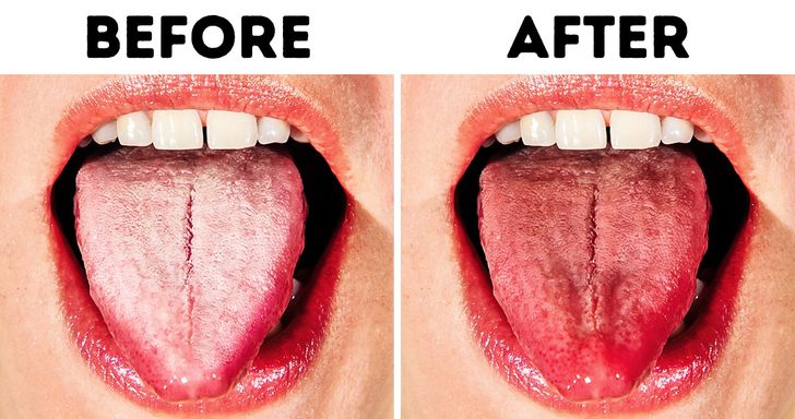 vogn vedhæng smuk 10 Ways to Get Rid of White Tongue and Make It Healthier / Bright Side