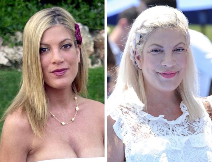 How Plastic Surgery Dramatically Changed These Celebrities