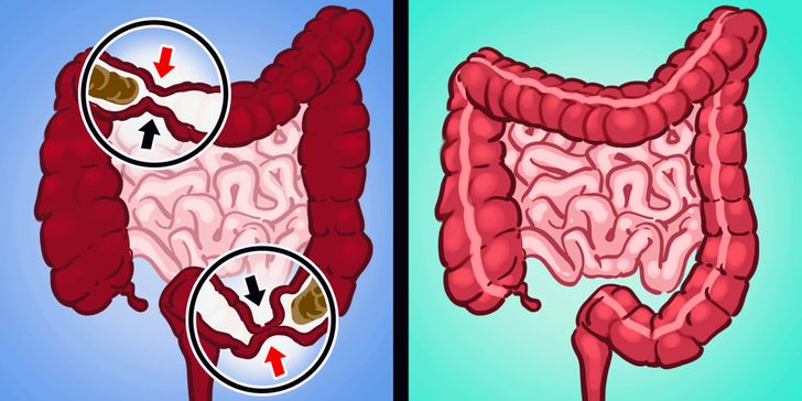 6 Quick Ways to End Your Constipation