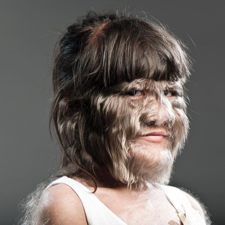 A young girl looks at the camera, she's covered in fur-like hair on her face.
