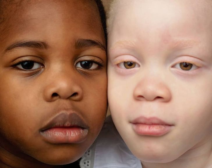 Twins With Different Skin Colors Astonished Their Mom When They Were Born