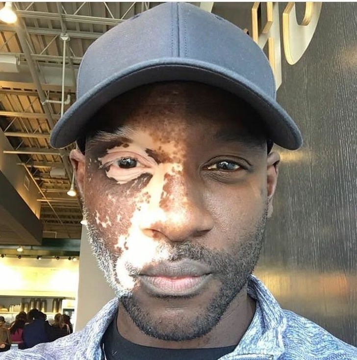 Vitiligo pada wajah.