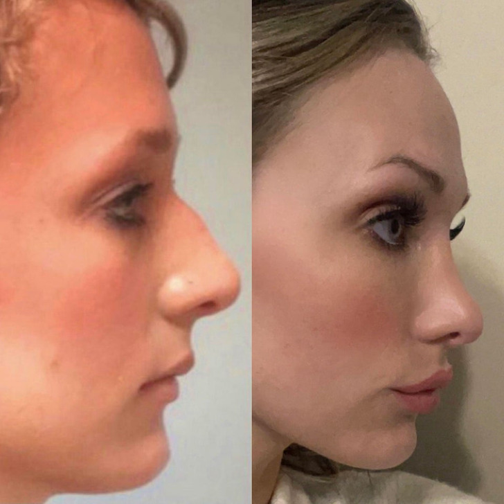 18 People Who Opted for Plastic Surgery to Change Their Look and Improve Their Self-Esteem