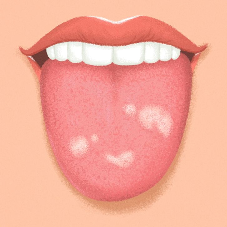 9 Things Your Tongue Is Trying to Tell You About Your Health