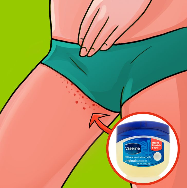 10 Effective Ways To Prevent A Rash On The Inner Thighs