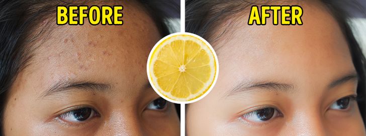 7 Foods That Will Reduce Acne Scars