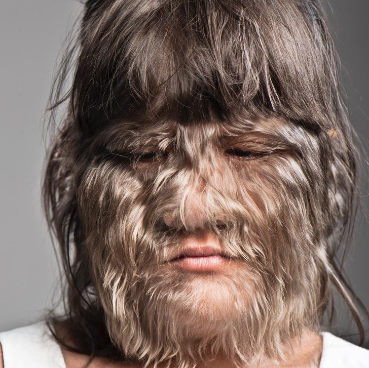 Natty grew up in a loving family, but not everyone was understanding of her condition. Close-up of a little girl looking sad, her face covered with fur-like hair.