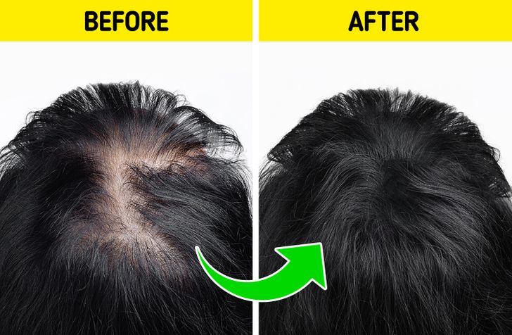 Top 5 hair regrowth success stories  Dr Batras