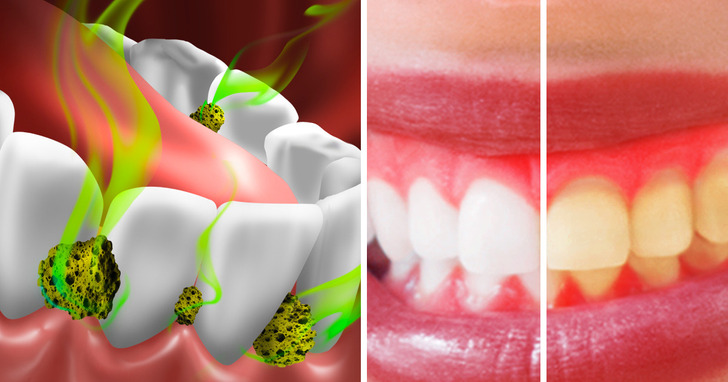 7 Ways to Kill Bacteria in Your Mouth and Stop Bad Breath