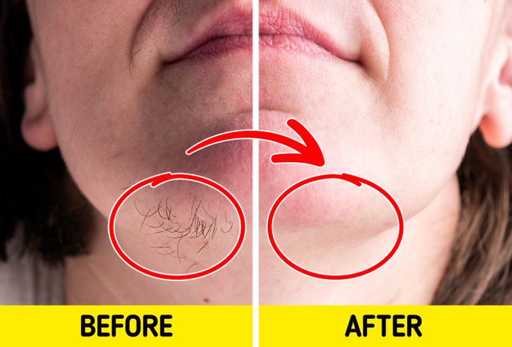 9 Simple Ingredients to Get Rid of Facial Hair at Home
