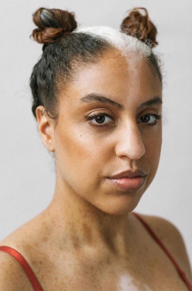 A Photographer With Vitiligo Captures the Beauty of Women With the Same Condition, and It’s a Sight to Behold