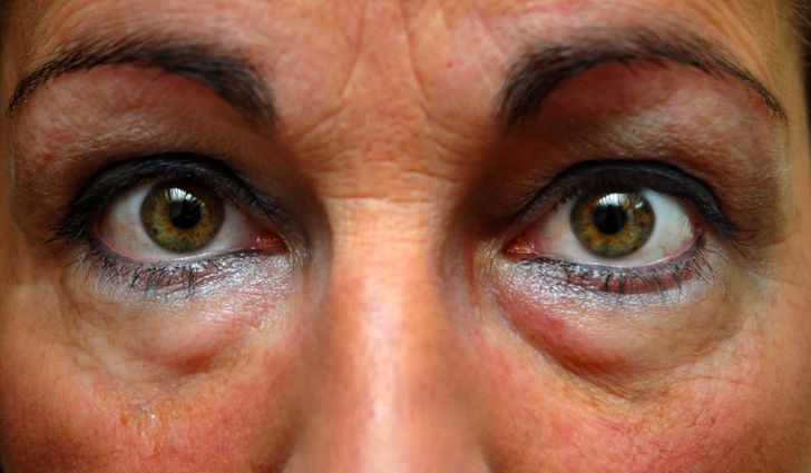 Why We Get Dark Circles and How to Get Rid of Them
