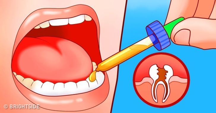 11 Effective Things You Can Do To Stop Wisdom Tooth Pain