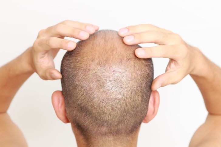 What Causes Scalp Pain and 10 Home Remedies to Relieve It